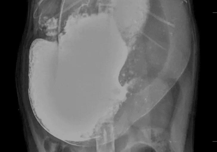 Diagnosis, treatment and discussion of a case of cat intestinal foreign body